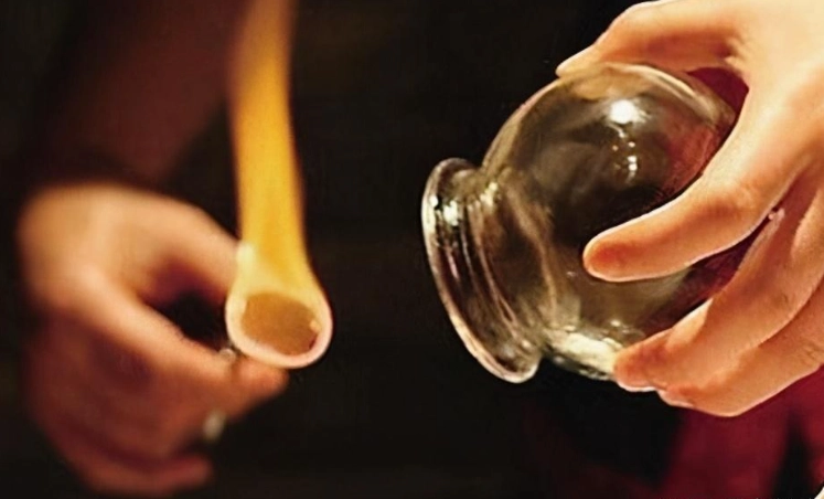 拔罐後瘀青處理 拔罐後瘀青處理