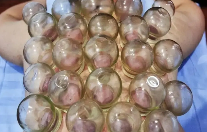 拔罐黑紫色原因 拔罐黑紫色原因