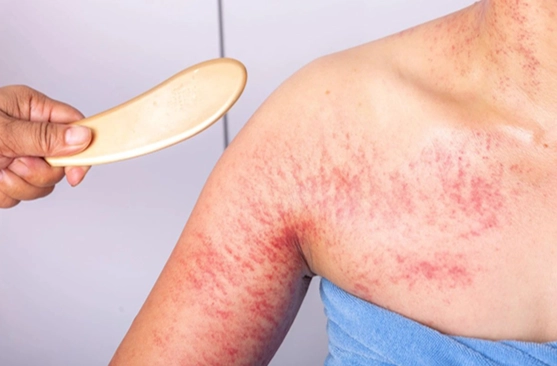 中暑腹瀉 中暑腹瀉