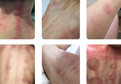 刮痧後注意事項