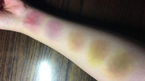 刮痧瘀青多久會好