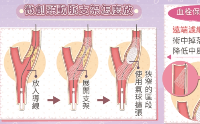 頸動脈剝離 看哪科