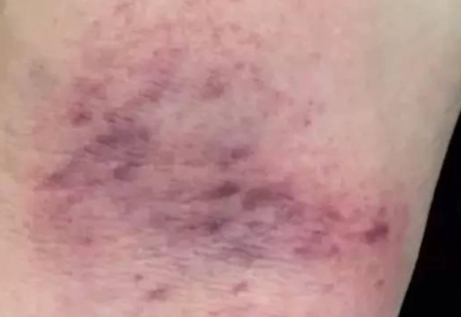 刮痧保健好處 刮痧保健好處