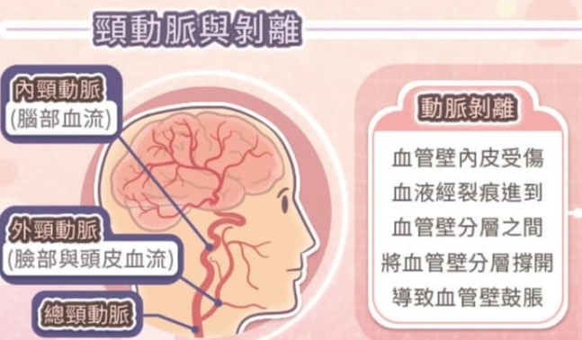 頸動脈剝離 症狀