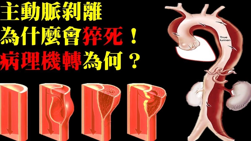 頸動脈剝離 看哪科