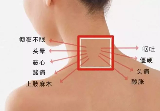脖子酸痛穴位 脖子酸痛穴位