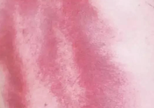 刮痧保健好處 刮痧保健好處