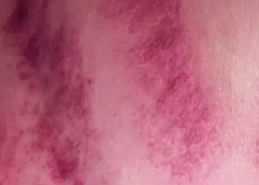 刮痧後瘀青正常嗎