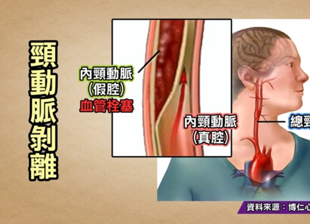 頸動脈剝離 治療