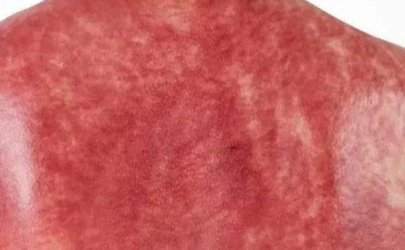 身體容易出痧原因