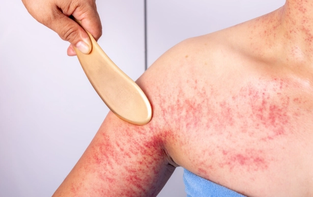 刮痧瘀青怎麼消