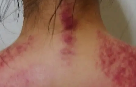 刮痧瘀血處理 刮痧瘀血處理