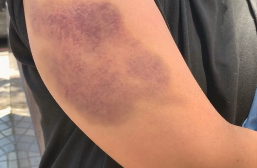 刮痧顏色代表什麼