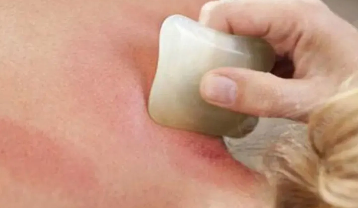 刮痧好處 刮痧好處