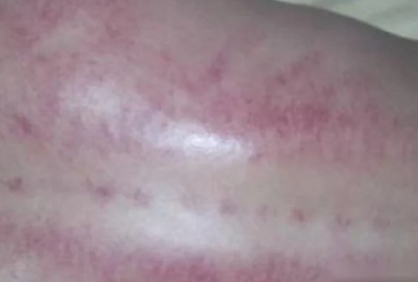 刮痧不出痧原因