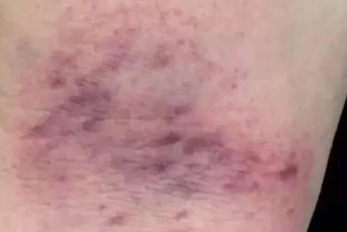 刮痧瘀青怎麼消