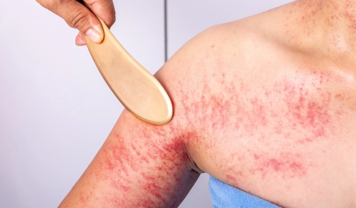 臉部刮痧紅腫 臉部刮痧紅腫