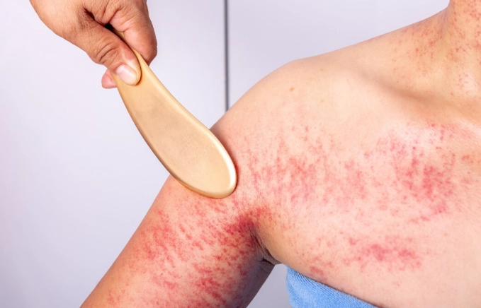 刮痧為什麼會出痧 刮痧為什麼會出痧