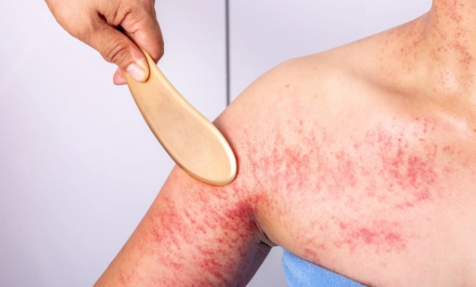 刮痧後皮膚變黑 刮痧後皮膚變黑