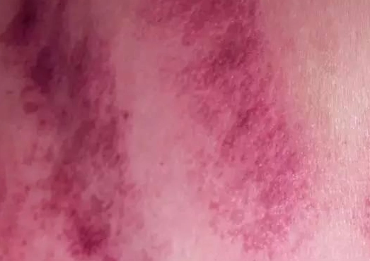 腿部刮痧後瘀青