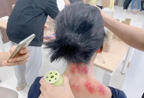 刮痧注意事項 刮痧注意事項