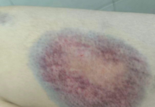 刮痧顏色代表什麼