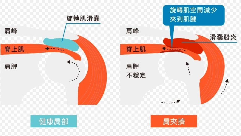 肩膀疼痛治療 肩膀疼痛治療