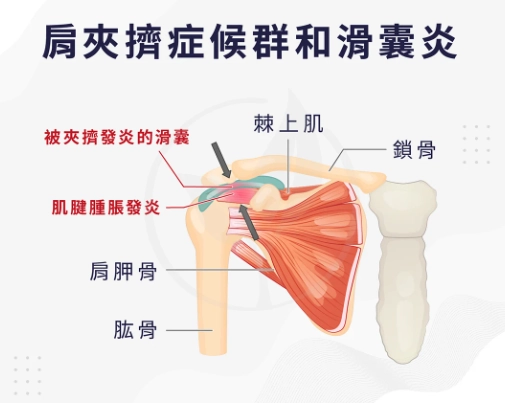 肩關節夾擠症候群 肩關節夾擠症候群