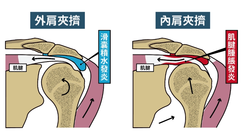 肩膀疼痛治療 肩膀疼痛治療