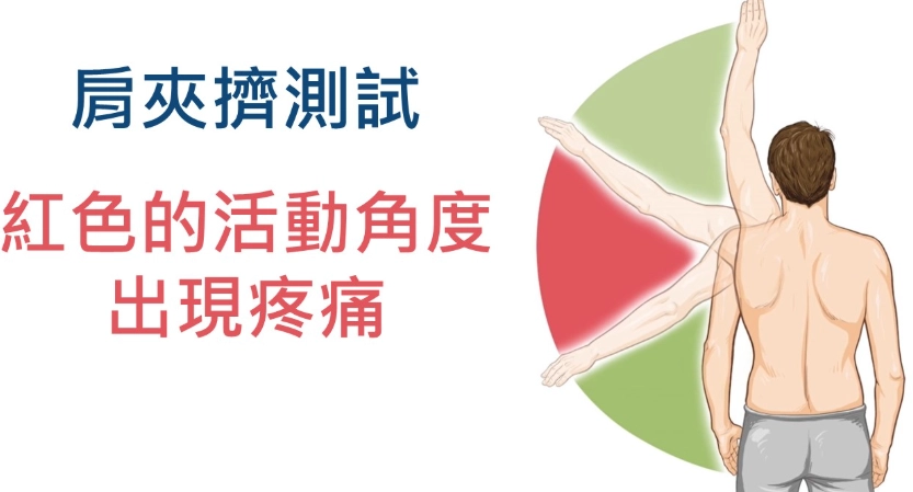肩膀疼痛治療 肩膀疼痛治療