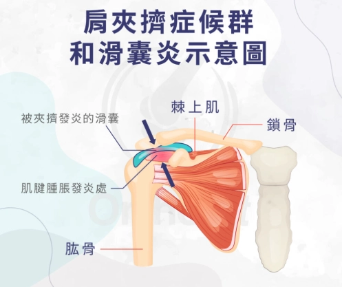 肩關節夾擠症候群 肩關節夾擠症候群